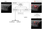 Ultrasound detection of subquadricipital recess distension