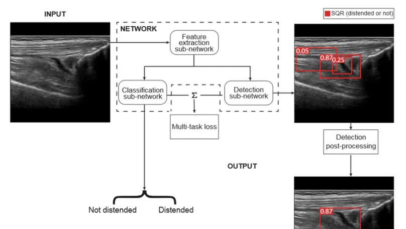 Ultrasound detection of subquadricipital recess distension